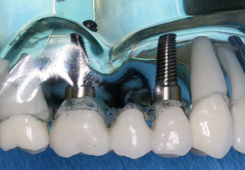 Figure 3: model of a fixed partial denture (bridge) on 2 dental implants.