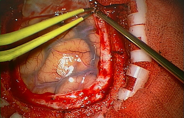 Figure 8: Surgery on the brain.