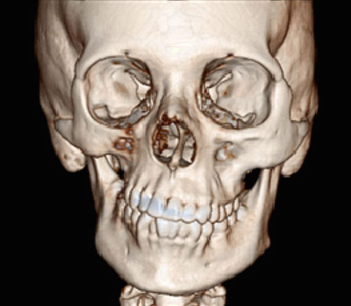 Figure 10: 3D reconstruction of the CT scan of a 17 year old girl affected with Parry Romberg syndrome. Bone reconstruction.