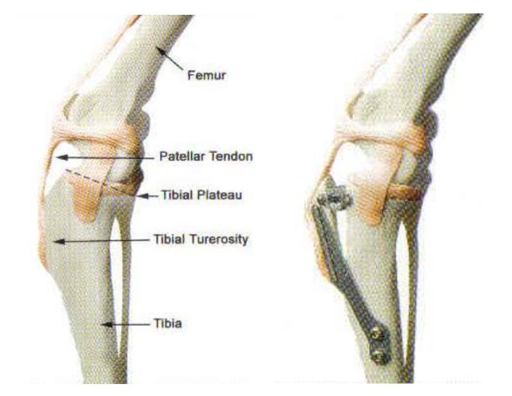 Tibia csontgraft-Dr. Gál Sándor