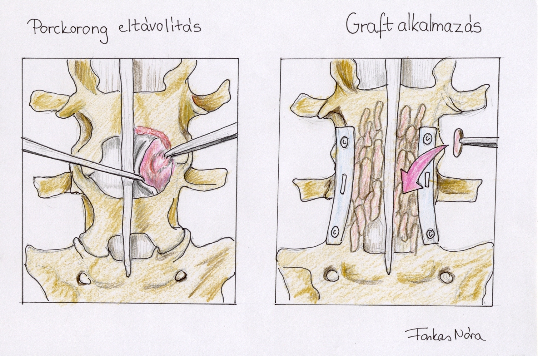 'Csontgraft használata porckorongproblémák esetén - saját rajz