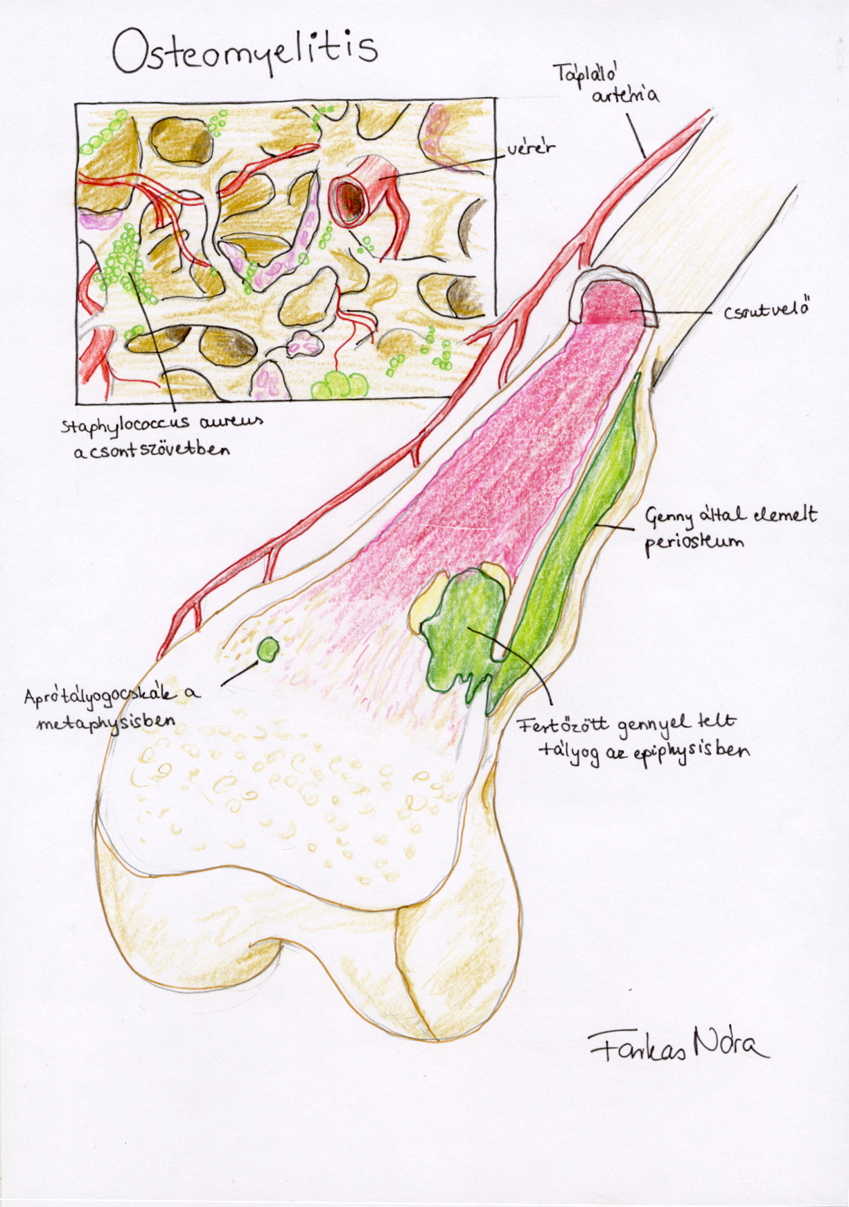 Osteomyelitis- saját rajz
