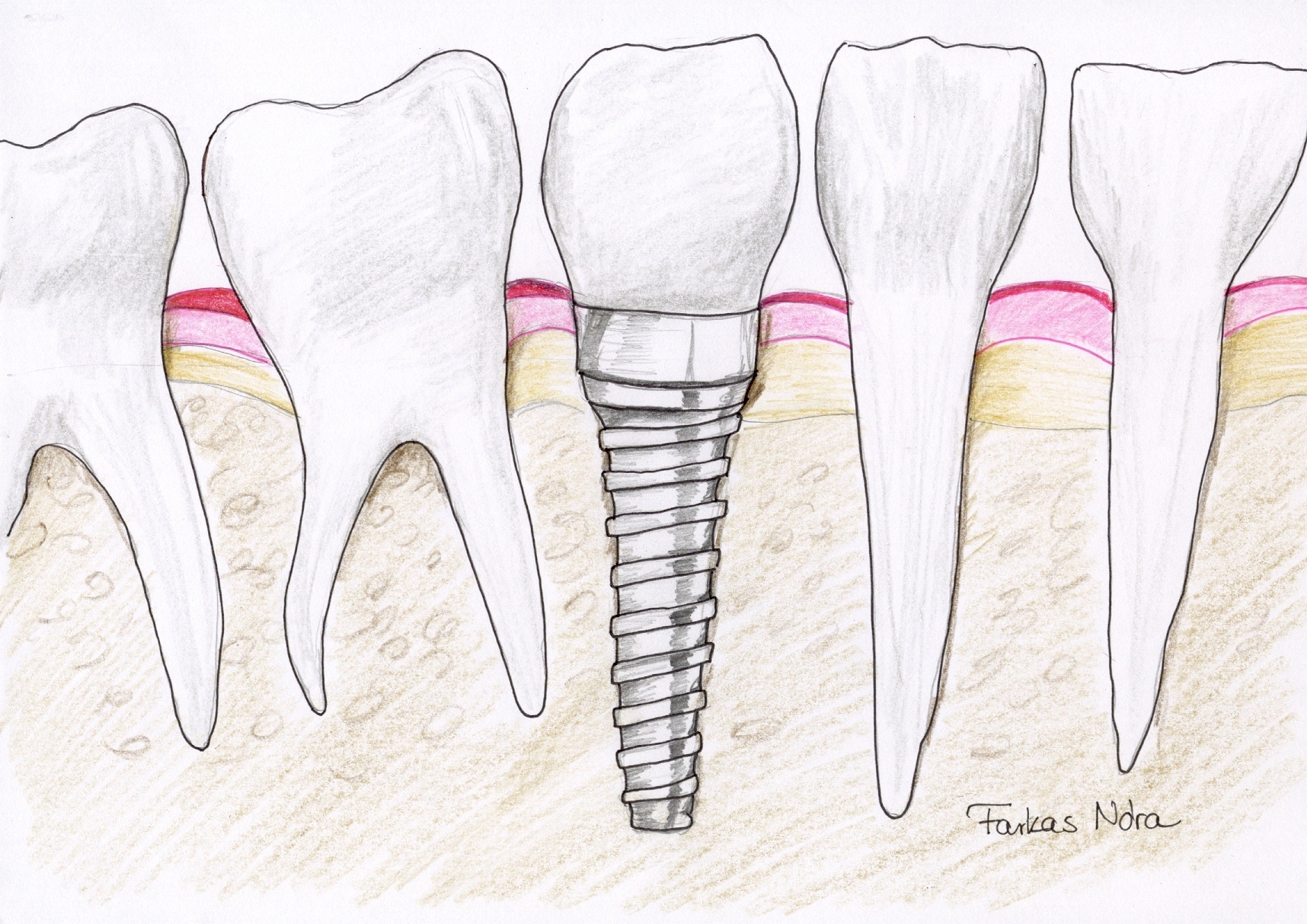 Fogbeültetés titán fog implantátummal- saját rajz