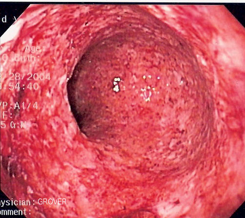 Crohn betegség