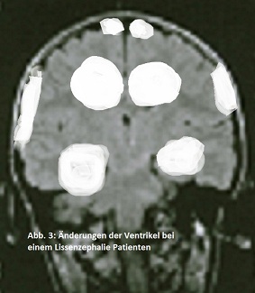 Abb. 3: Änderungen der Ventrikel bei einem Lissenzephalie Patienten