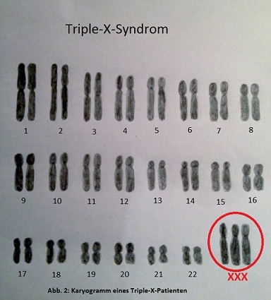 Abb. 2: Karyogramm eines Triple-X-Patienten