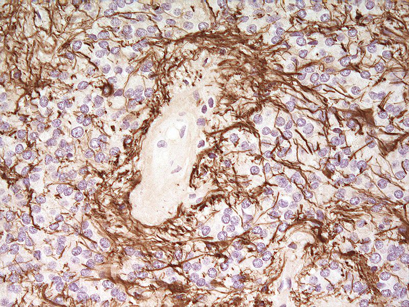 Gliosis  due to ependymoma (brain tumor)