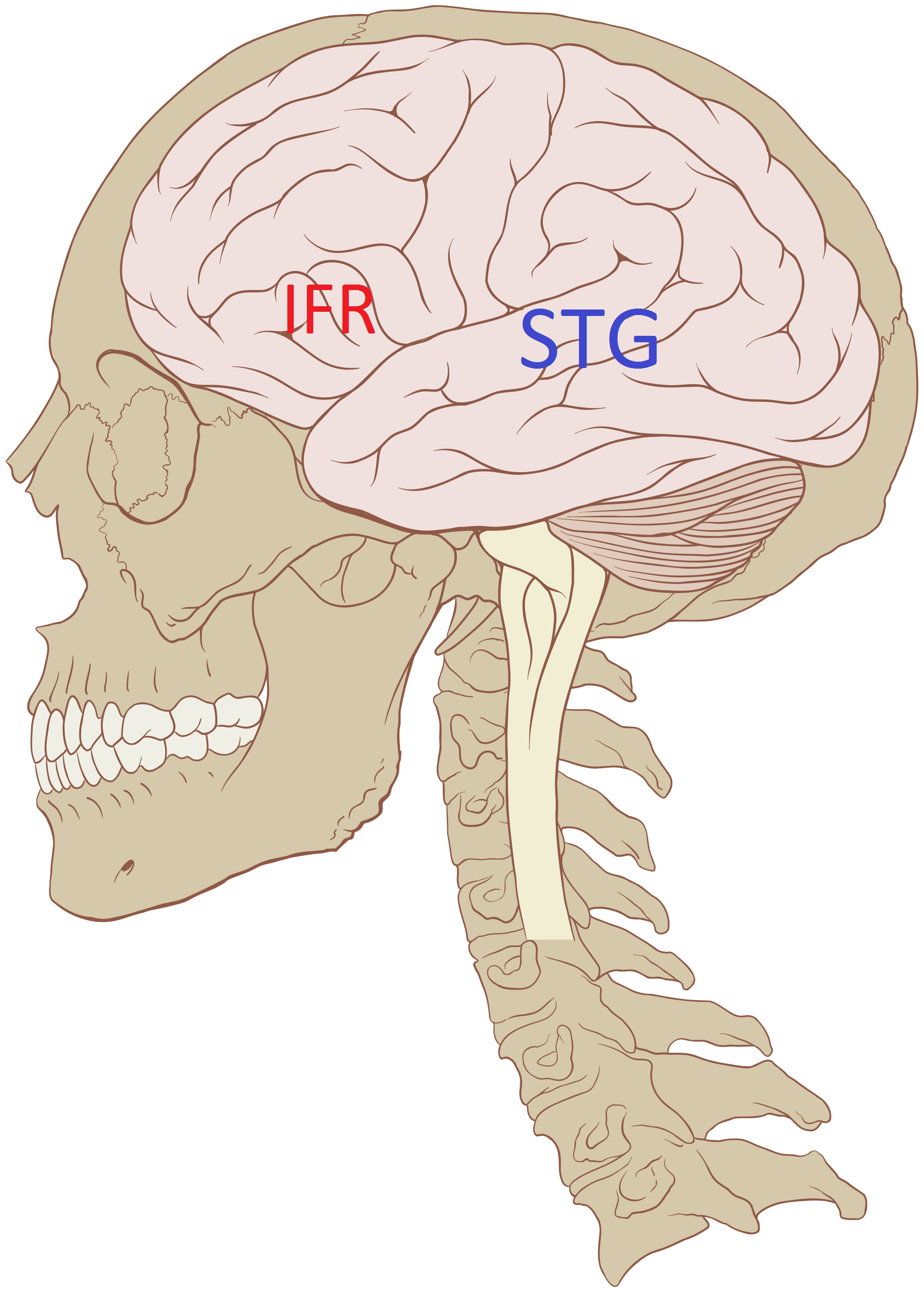 IFR=inferior frontális gyrus(Broca area, STG=superiro temporális gyrus(Wernicke area)