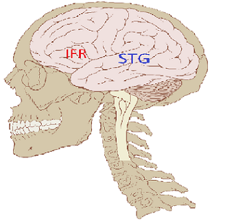 IFR=inferior frontális gyrus,STG=superior temporális gyrus