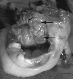 ovarian remanant syndrome