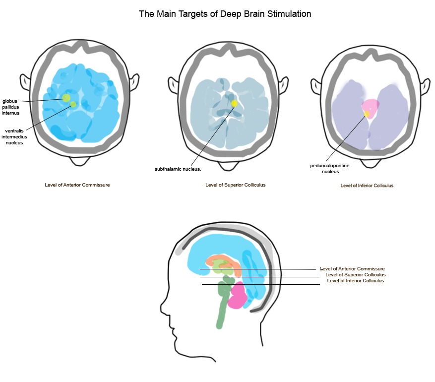 The Main Targets of Deep Brain Stimulation