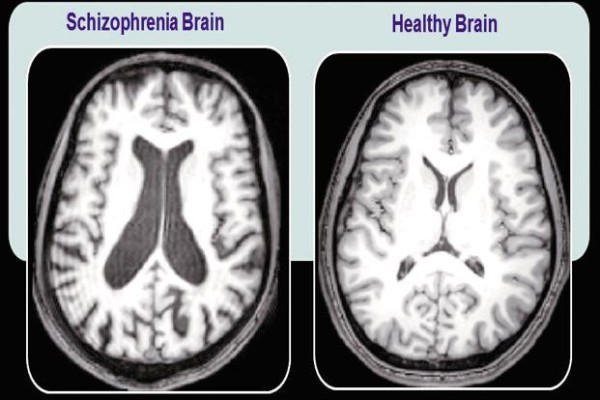 brains-photo1-600x400.jpg