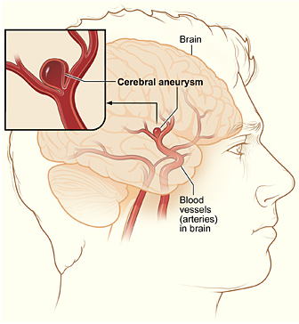 Intracranialis aneurysma