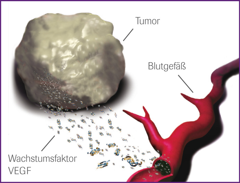 Angiogenese bei Tumoren