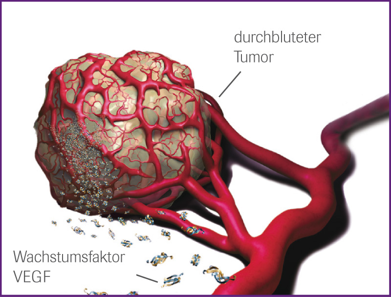 Angiogenese bei Tumoren