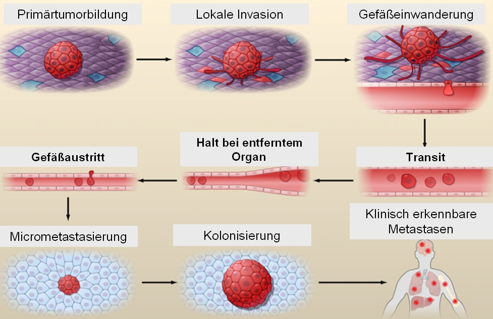 Metastasierung